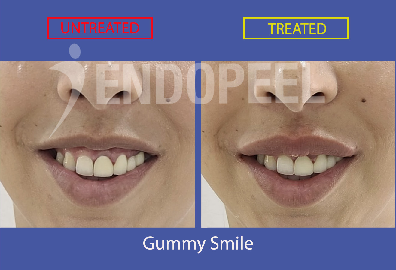 gummy-smile-intro